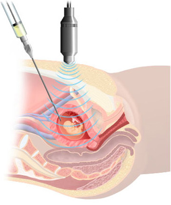 Amniocentesis Needle