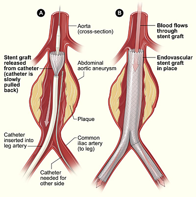 Dilated Aorta