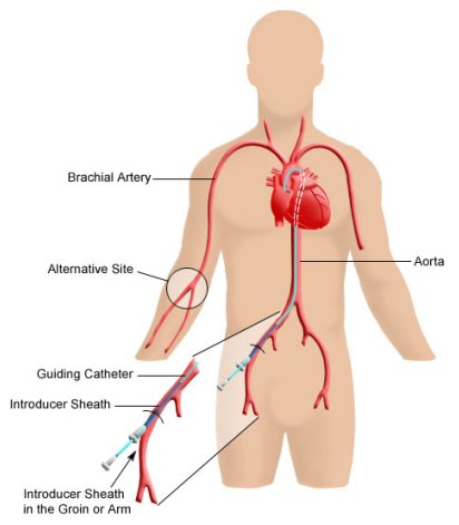 Catheter Heart