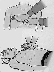 cardiac massage