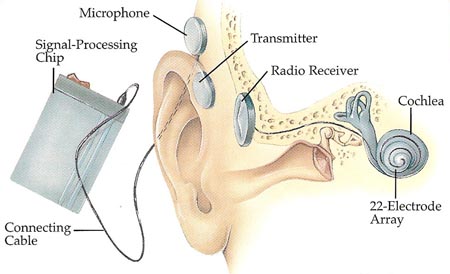 cochlear_implant_diagram.jpg