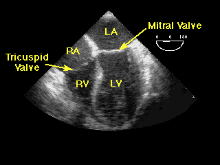 abnormal echocardiogram results