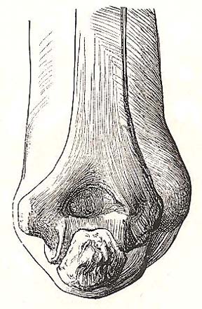 Relation of bones of the elbow to the surface. Dorsal view; elbow bent