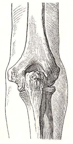 Relation of bones of the elbow to the surface. Dorsal view; elbow fully extended