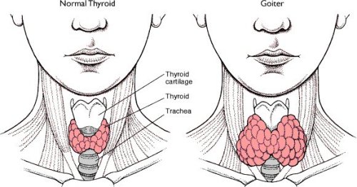 Thyroid Swelling