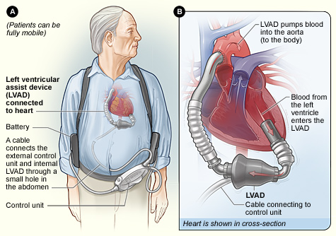 implantable ventricular assist device