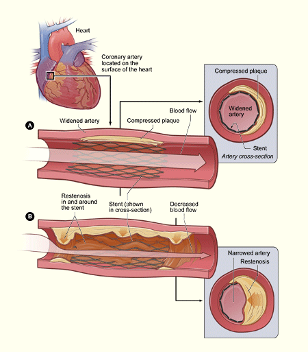 Coronary Dissection