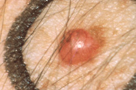Red Skin Cancer