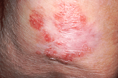 Red Patch On Face Itchy Rash