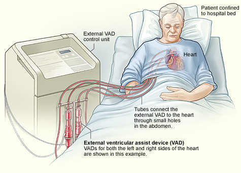 transcutaneous ventricular assist device
