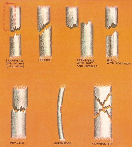 fractures types
