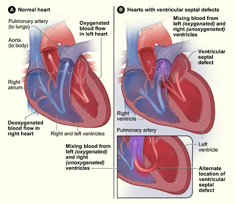 Septum In Heart