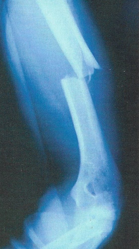 fracture of the humerus